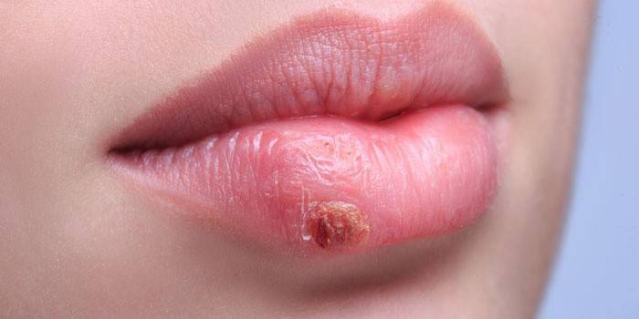 Herpes labial