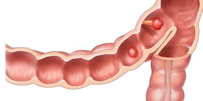 Pólipos na parede intestinal