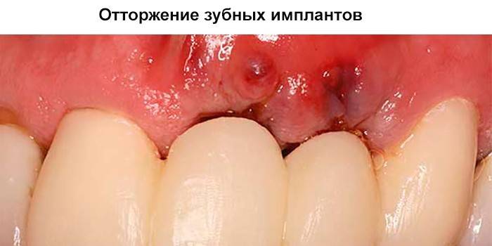 Odrzucenie implantu dentystycznego
