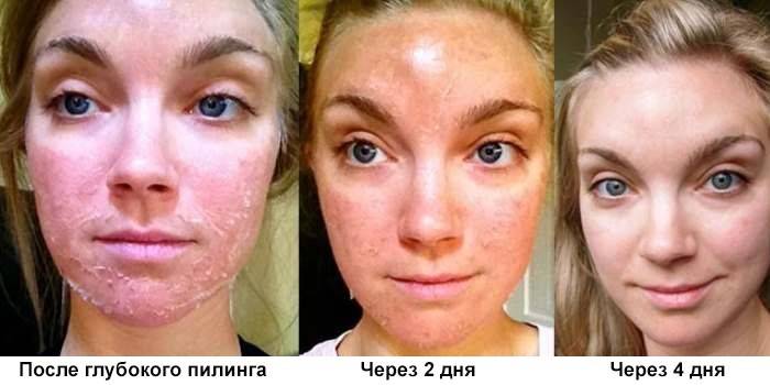 O resultado do peeling profundo