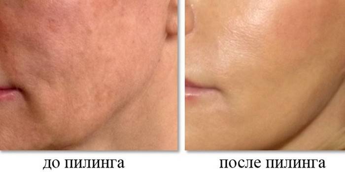 Fotos antes e depois do peeling químico