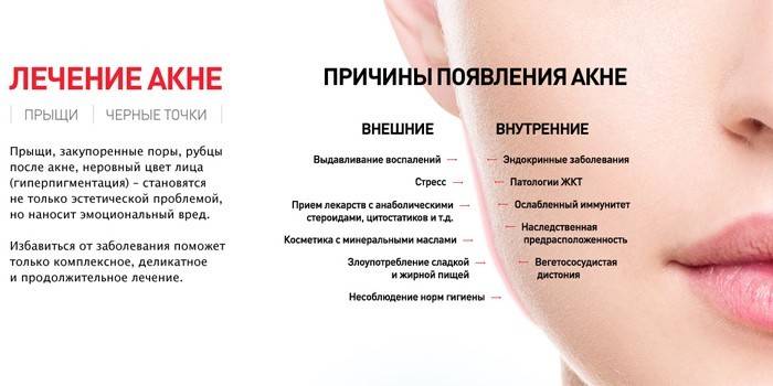 Causas da acne