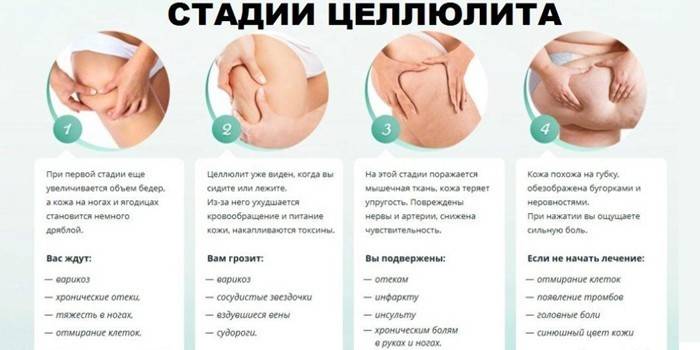 Stadium lipodystrofii