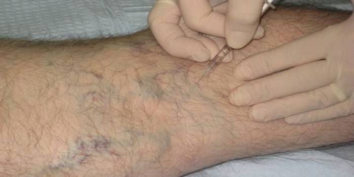 Inyección de ozono para tromboflebitis