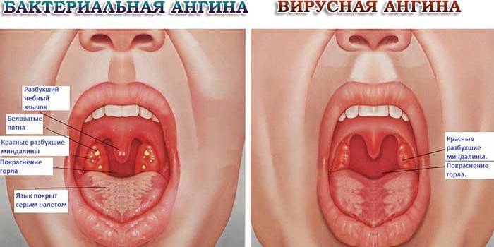 Amigdalitis bacteriana y viral.