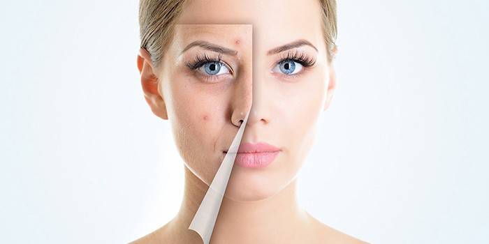 Livrar-se da acne em seu rosto