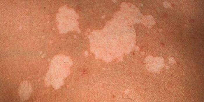 Pitiríase versicolor na pele humana