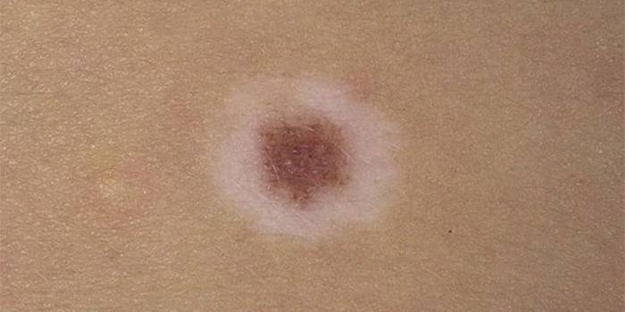 Settonov Nevus na koži