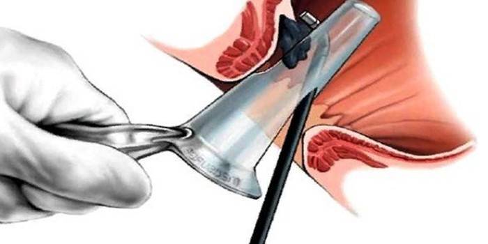 Esquema de extracción de cono de hemorroides