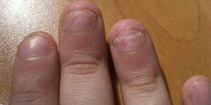 Onicólise Dermatológica
