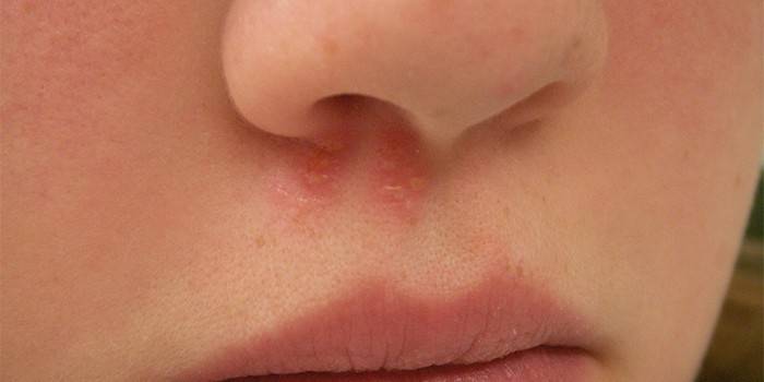 Herpes v nose dieťaťa