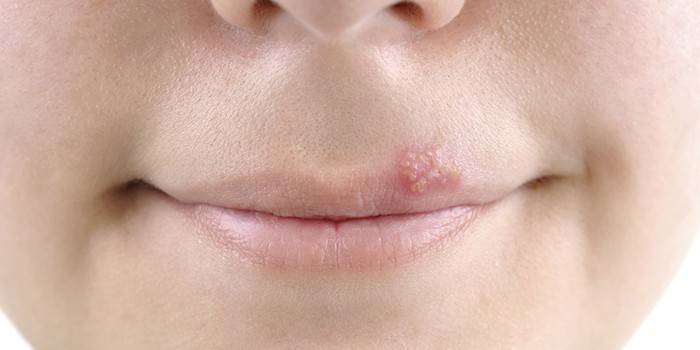 Herpes na hornej pery