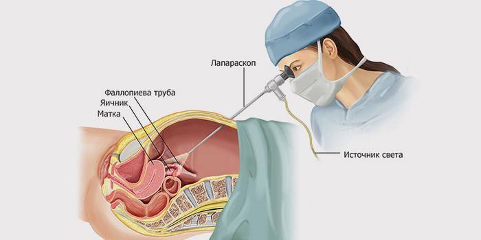 Esquema de laparoscopia.