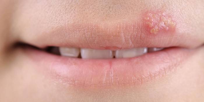Herpes na hornej pery