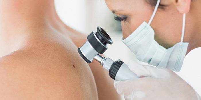 Um médico realiza uma dermatoscopia de uma toupeira