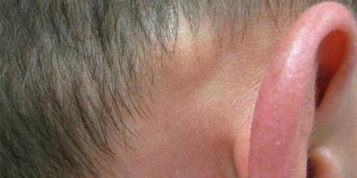 El tipo tiene fibroma detrás de la oreja.
