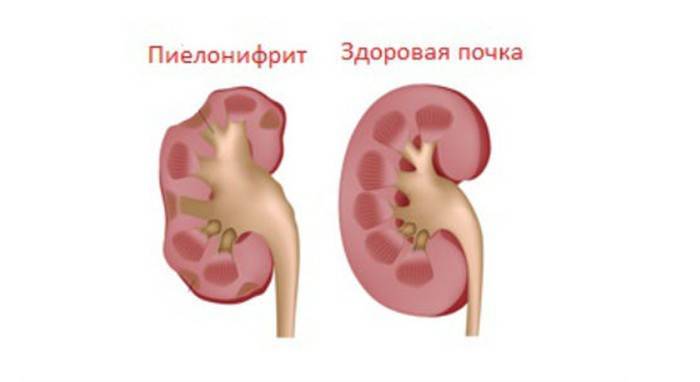 Esquema de un riñón sano y pielonefritis afectada