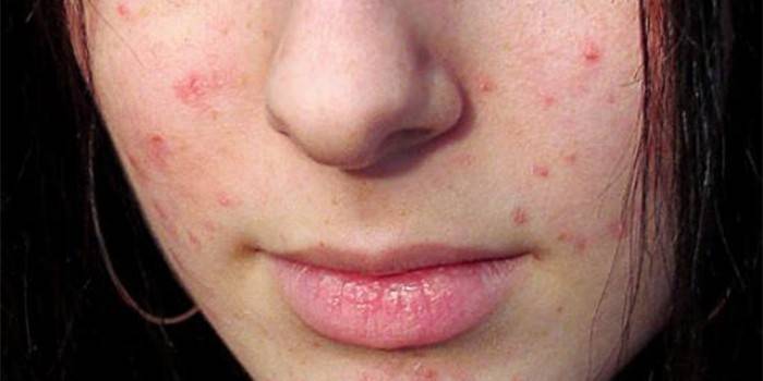 Acne no rosto da menina