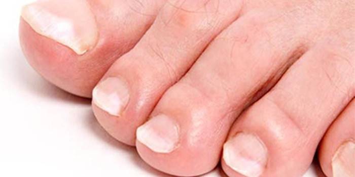 Onicólise das unhas dos pés