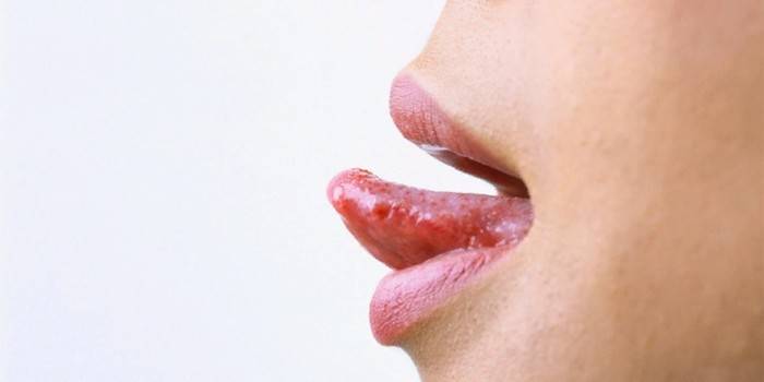 Manifestações de herpes na língua de uma menina