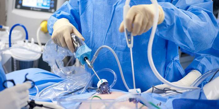 El cirujano realiza la laparoscopia.