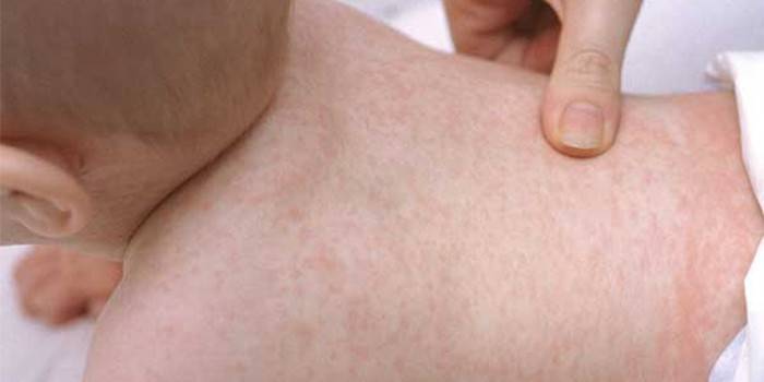 Manifestações do vírus do herpes nas costas de uma criança