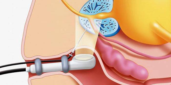 Figura biopsia transrectal de próstata