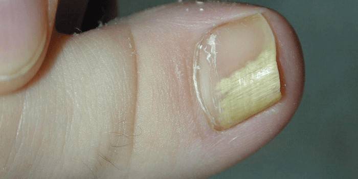 Palec dotknięty infekcją grzybiczą