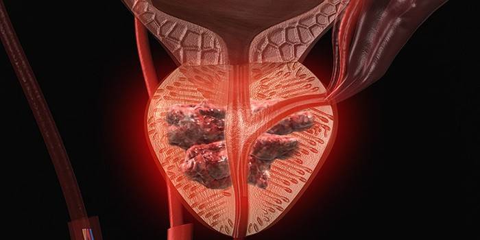 Imagem do adenoma da próstata