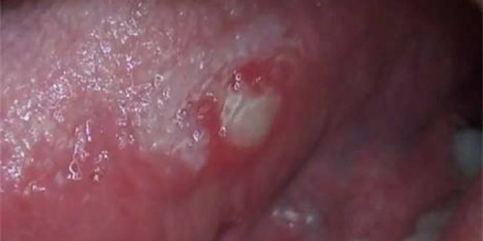 A manifestação do vírus da herpes na língua