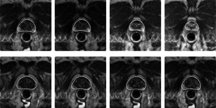 Výsledky MRI prostaty
