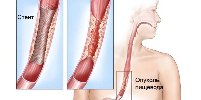 Stent de cáncer de esófago
