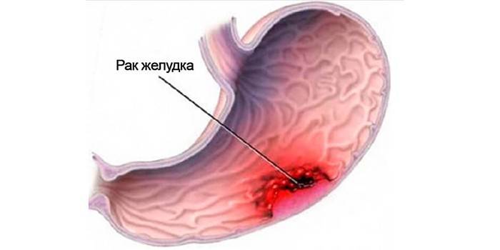 Tumor oncológico en el estómago