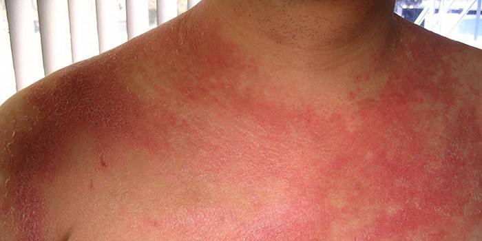 Psoriasis en el pecho en un hombre.