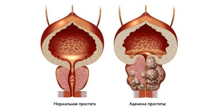 Zdrowa prostata i gruczolak prostaty