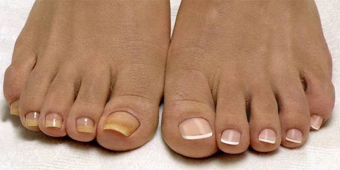 Uñas enfermas y sanas