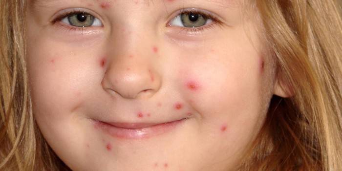 A garota tem acne no rosto