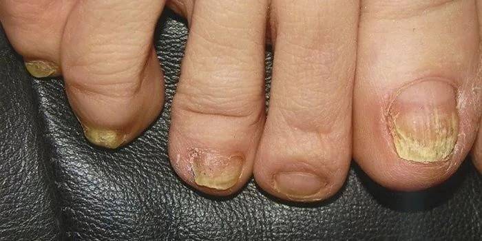 dermatofyty