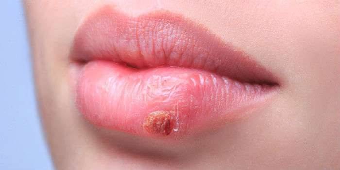 Herpes no lábio inferior