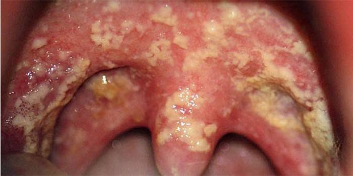 Candidiasis de la laringe humana