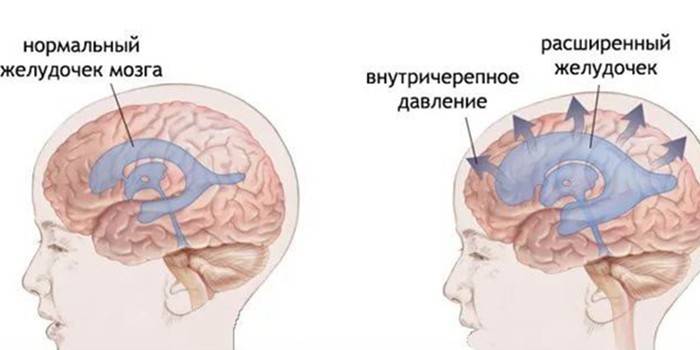 Diagrama del cerebro normal y cambios en la presión intracraneal.