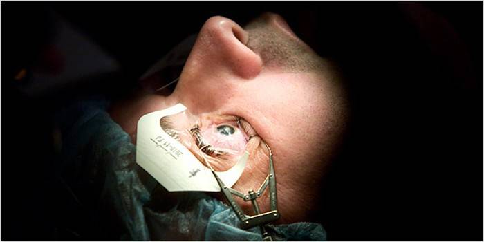 Un hombre antes de una cirugía ocular con un dilatador en la órbita.