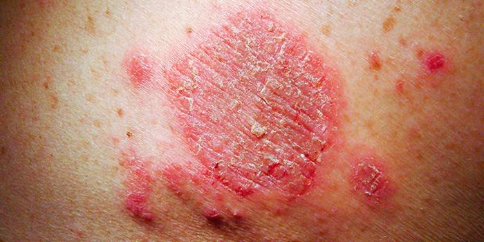 Manifestações de eczema na pele humana