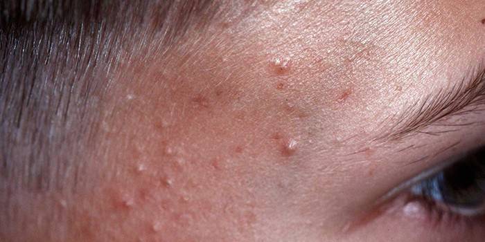 Acne no templo para o menino