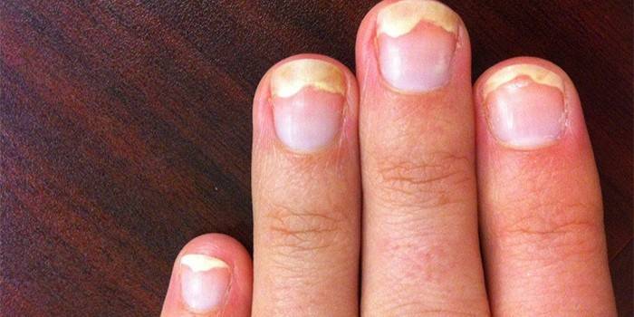 Onicólise das unhas