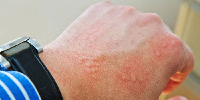 Eczema disidrótico na pele da mão