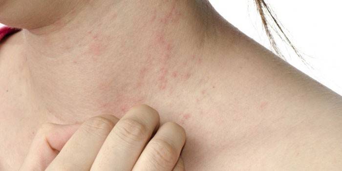 Dermatitis en el cuello de una mujer.
