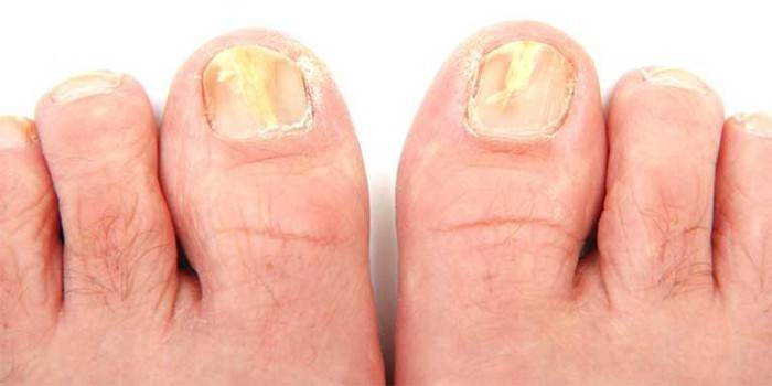 Hongos en las uñas de los pies