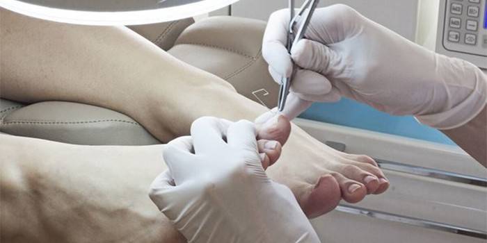 Médico remove uma unha