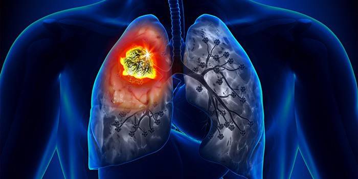 Esquema de un cáncer de pulmón.